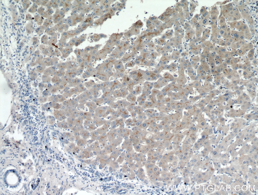 IHC staining of human hepatocirrhosis using 21220-1-AP