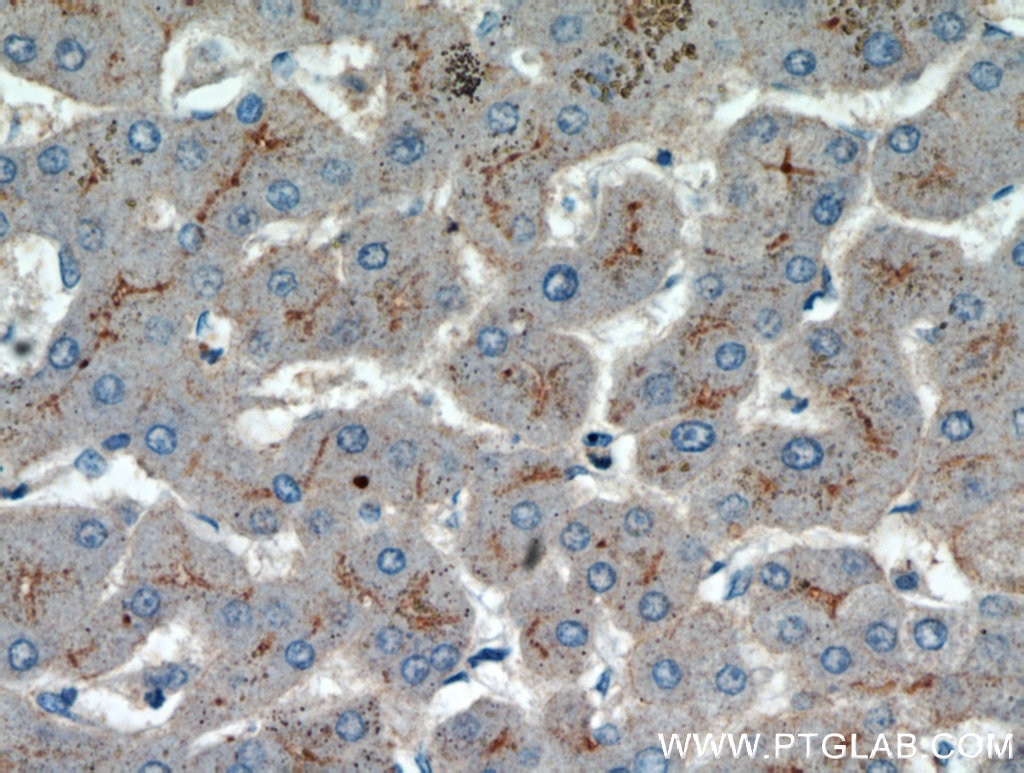 Immunohistochemistry (IHC) staining of human hepatocirrhosis tissue using AAMP Polyclonal antibody (21220-1-AP)