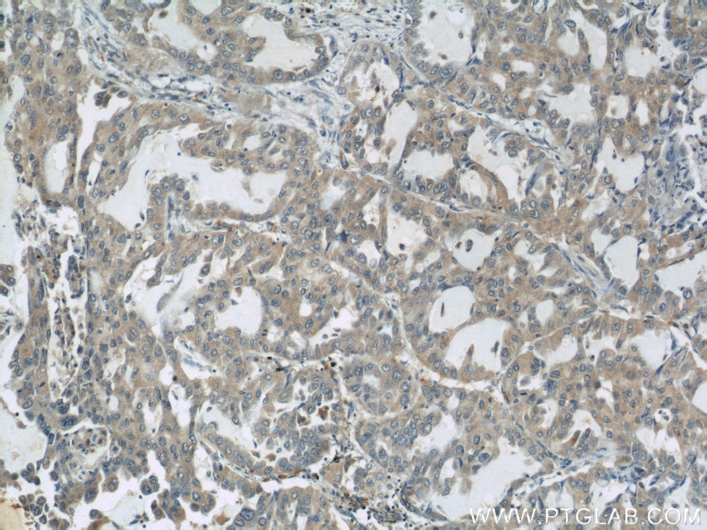 Immunohistochemistry (IHC) staining of human lung cancer tissue using AARS2 Polyclonal antibody (22696-1-AP)