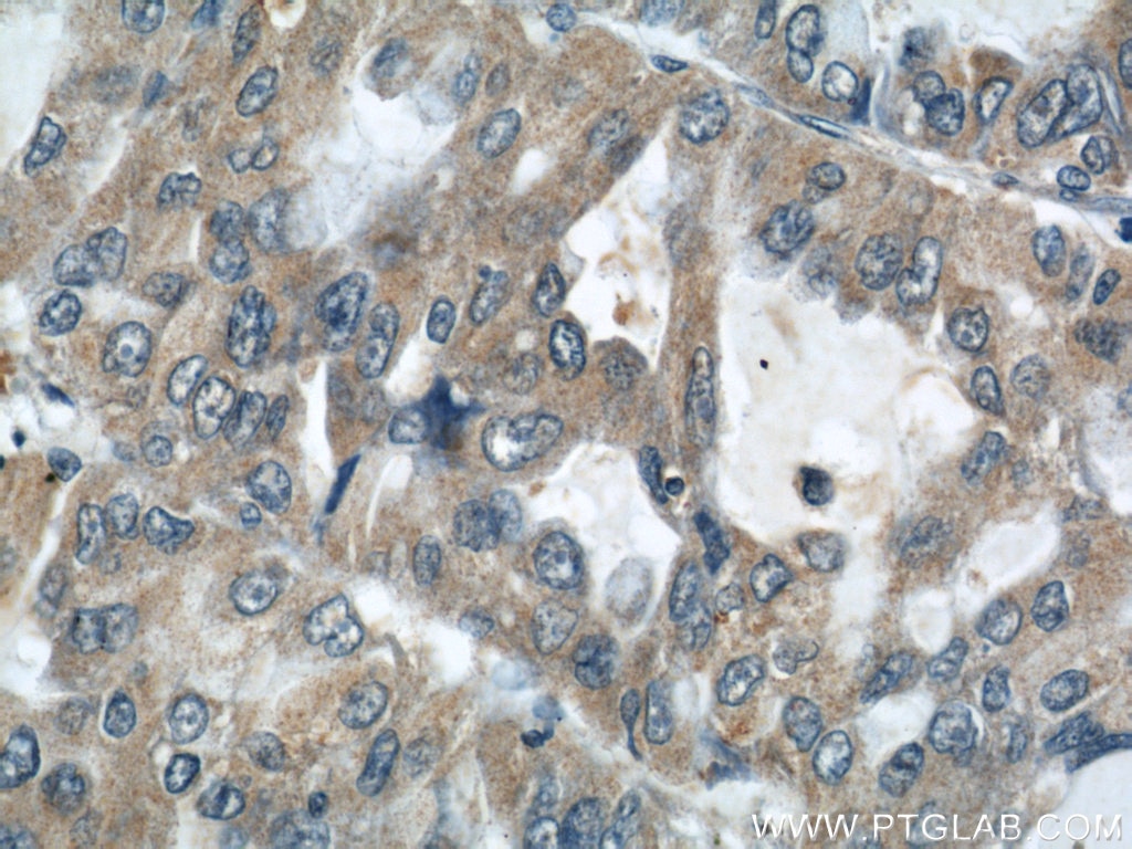 Immunohistochemistry (IHC) staining of human lung cancer tissue using AARS2 Polyclonal antibody (22696-1-AP)