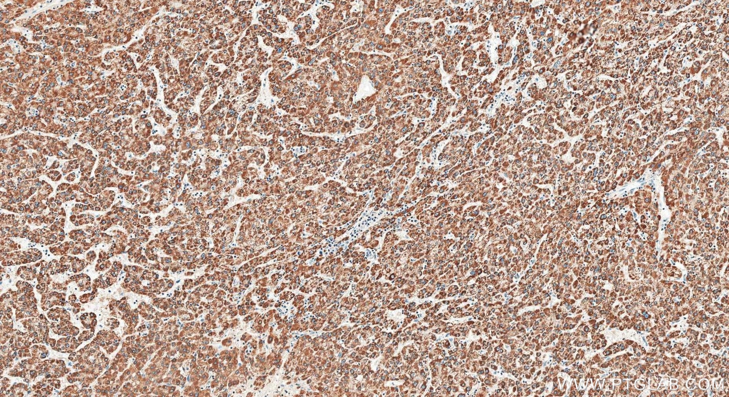 IHC staining of human liver cancer using 29354-1-AP Immunohistochemistry (IHC) staining of human liver cancer tissue using AASS Polyclonal antibody (29354-1-AP)
