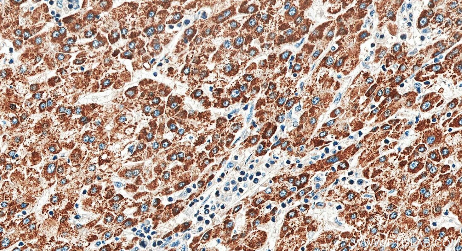 IHC staining of human liver cancer using 29354-1-AP Immunohistochemistry (IHC) staining of human liver cancer tissue using AASS Polyclonal antibody (29354-1-AP)