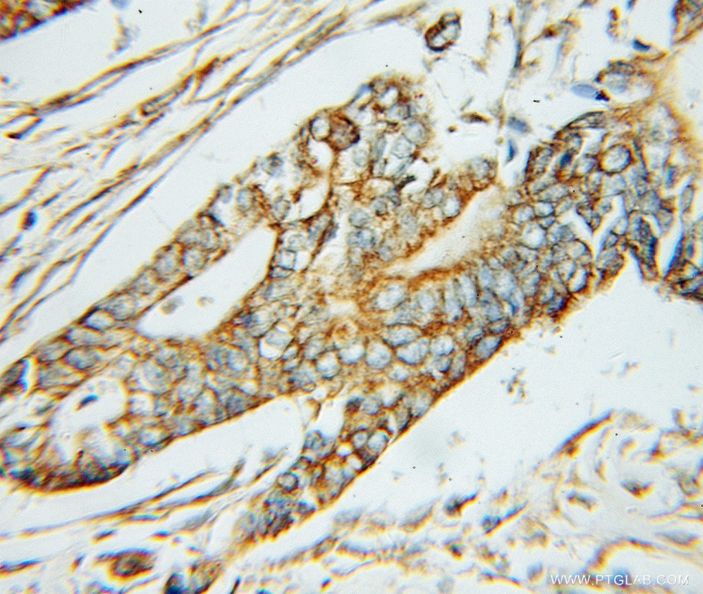 Immunohistochemistry (IHC) staining of human pancreas cancer tissue using ABAT Polyclonal antibody (11349-1-AP)