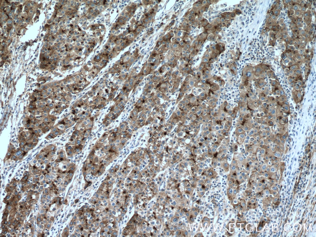 Immunohistochemistry (IHC) staining of human liver cancer tissue using P glycoprotein Polyclonal antibody (22336-1-AP)