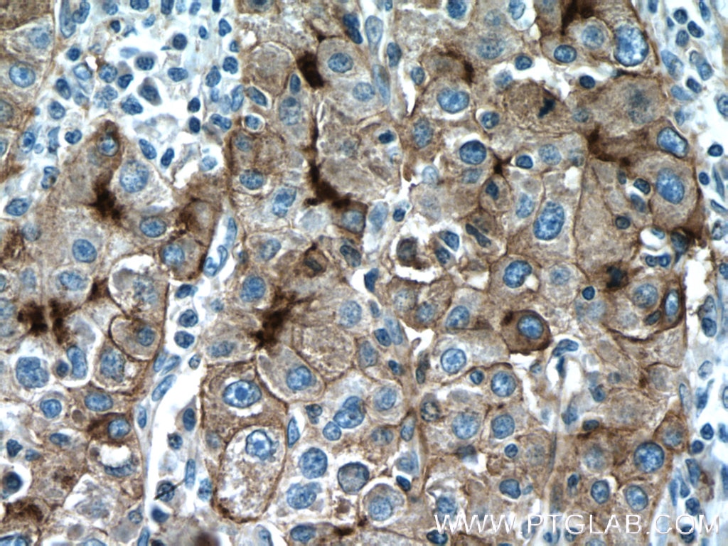 Immunohistochemistry (IHC) staining of human liver cancer tissue using P glycoprotein Polyclonal antibody (22336-1-AP)