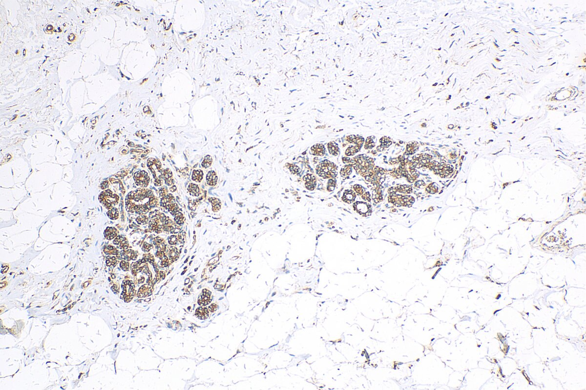 Immunohistochemistry (IHC) staining of human breast cancer tissue using ABCB6 Polyclonal antibody (14996-1-AP)