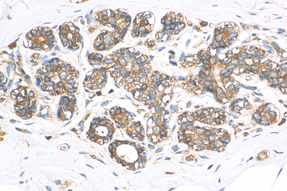 Immunohistochemistry (IHC) staining of human breast cancer tissue using ABCB6 Polyclonal antibody (14996-1-AP)