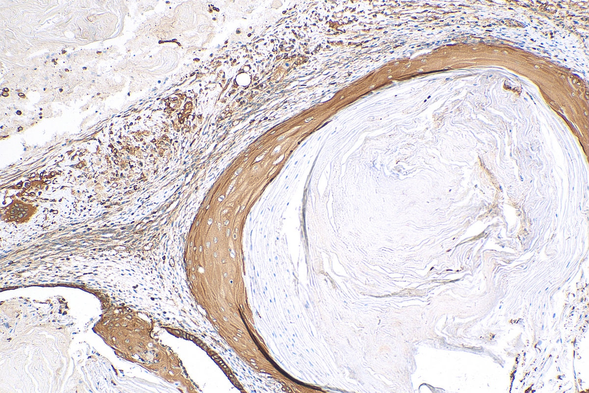 Immunohistochemistry (IHC) staining of human ovary tumor tissue using ABCB6 Polyclonal antibody (14996-1-AP)