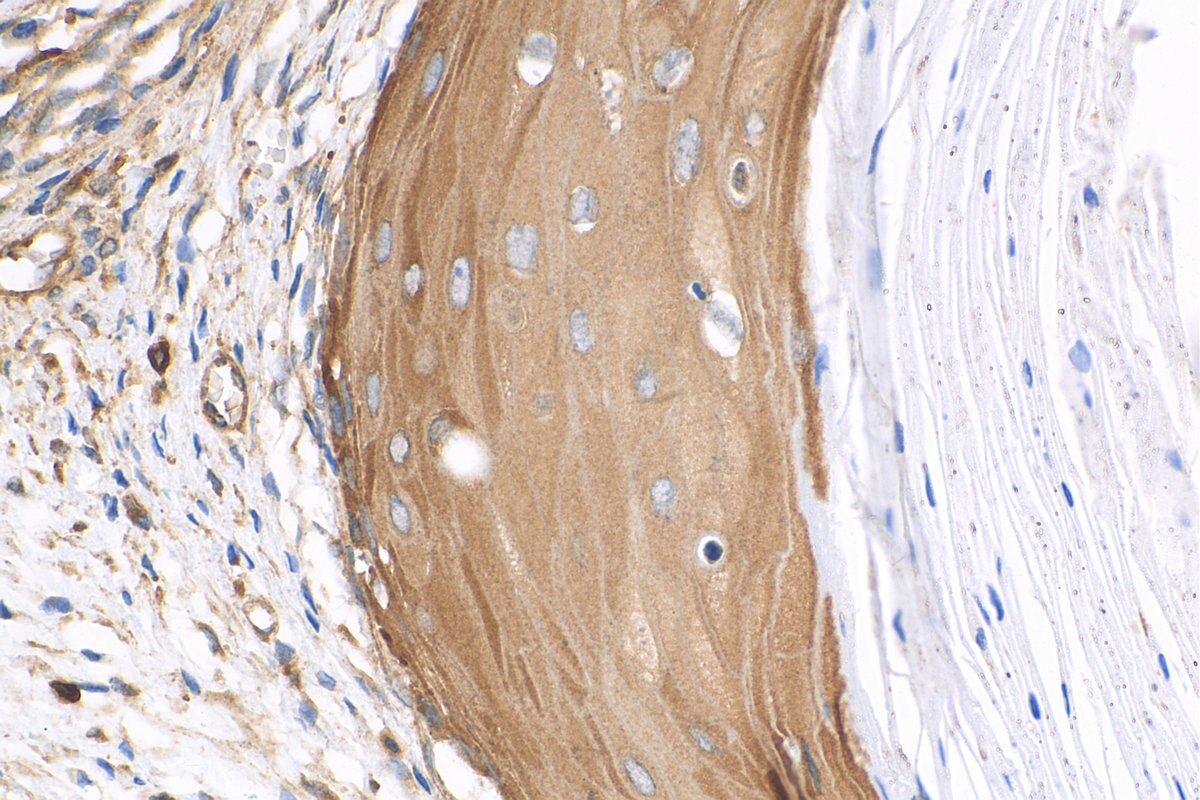 Immunohistochemistry (IHC) staining of human ovary tumor tissue using ABCB6 Polyclonal antibody (14996-1-AP)