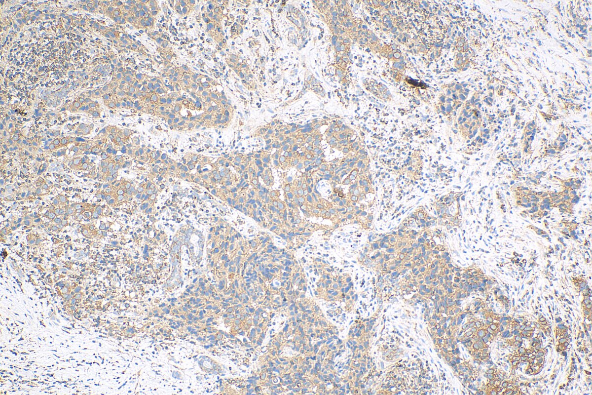 Immunohistochemistry (IHC) staining of human breast cancer tissue using ABCB6 Polyclonal antibody (14996-1-AP)