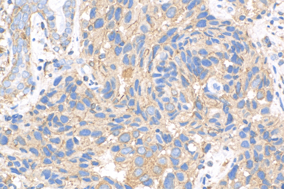 Immunohistochemistry (IHC) staining of human breast cancer tissue using ABCB6 Polyclonal antibody (14996-1-AP)