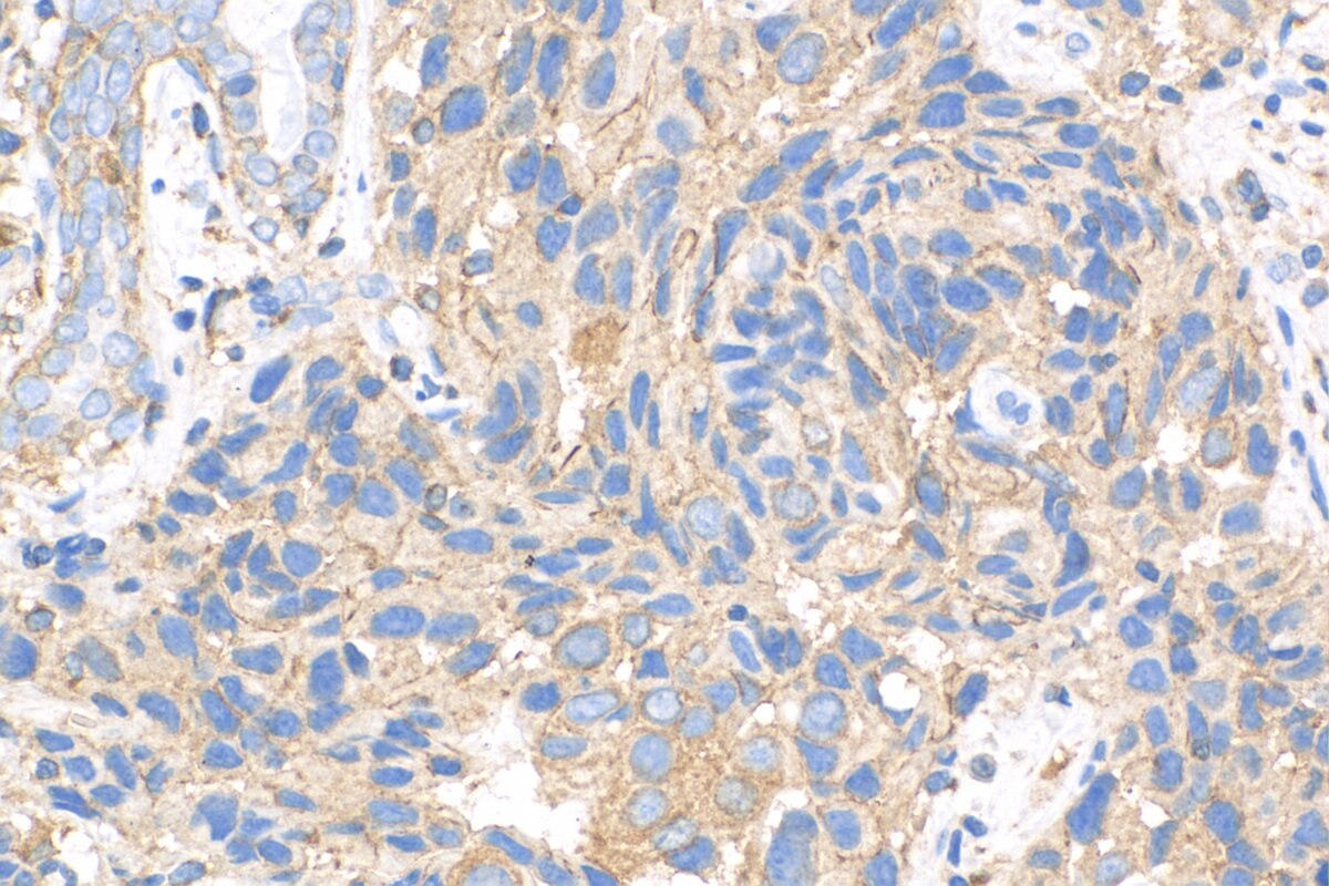 IHC staining of human breast cancer using 14996-1-AP