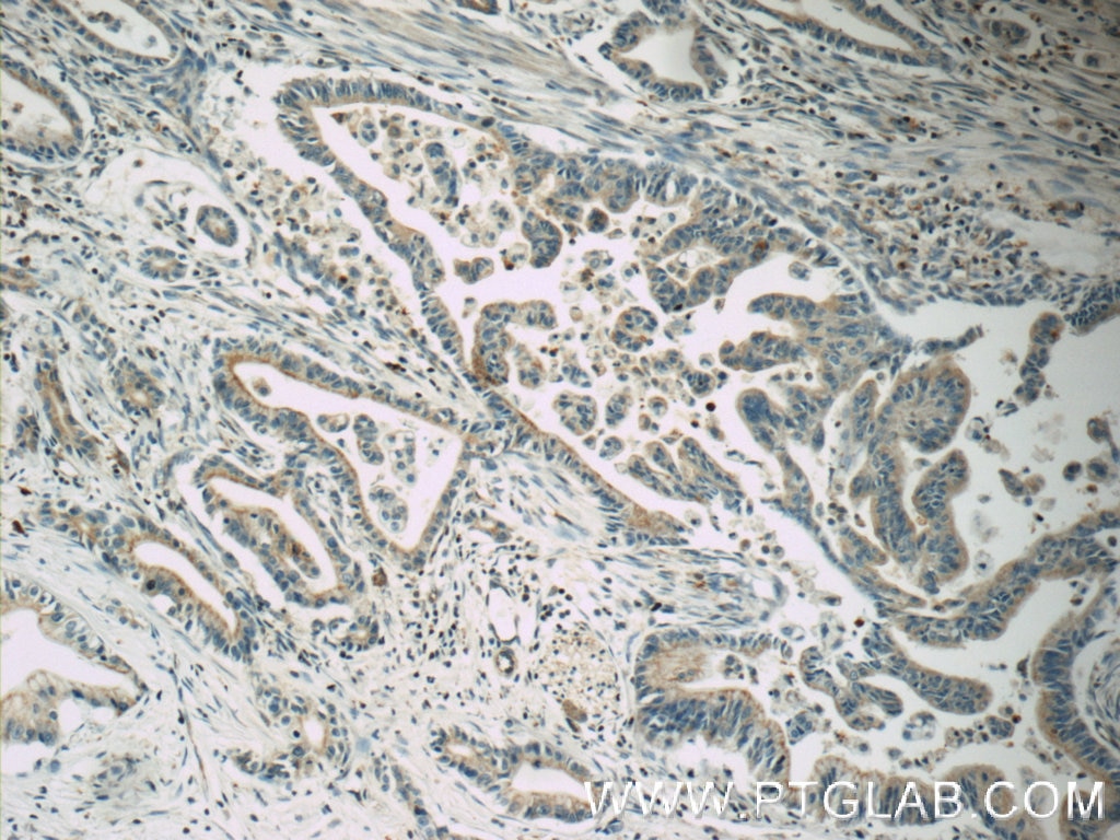 Immunohistochemistry (IHC) staining of human pancreas cancer tissue using ABCC5 Polyclonal antibody (19503-1-AP)