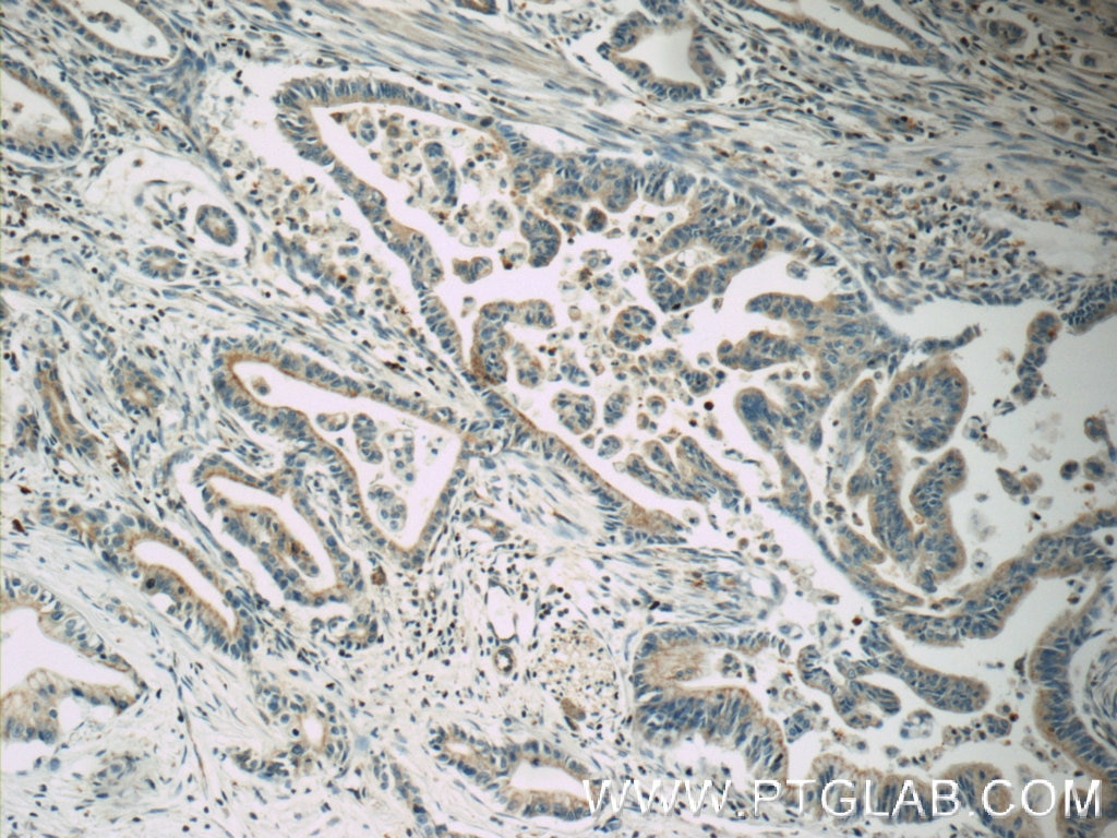 IHC staining of human pancreas cancer using 19503-1-AP