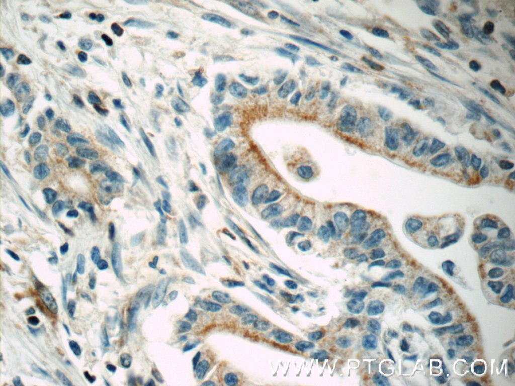 Immunohistochemistry (IHC) staining of human pancreas cancer tissue using ABCC5 Polyclonal antibody (19503-1-AP)