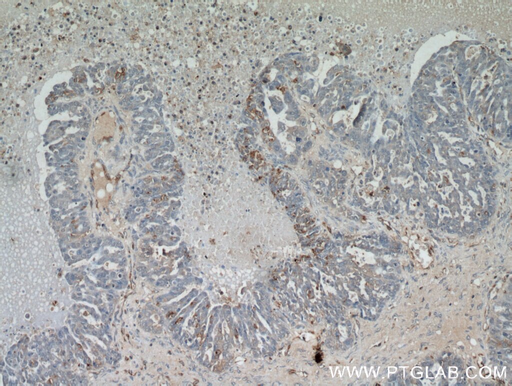 Immunohistochemistry (IHC) staining of human ovary tumor tissue using ABCC5 Polyclonal antibody (19503-1-AP)