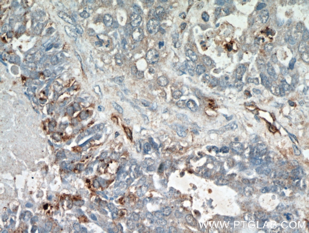 Immunohistochemistry (IHC) staining of human ovary tumor tissue using ABCC5 Polyclonal antibody (19503-1-AP)