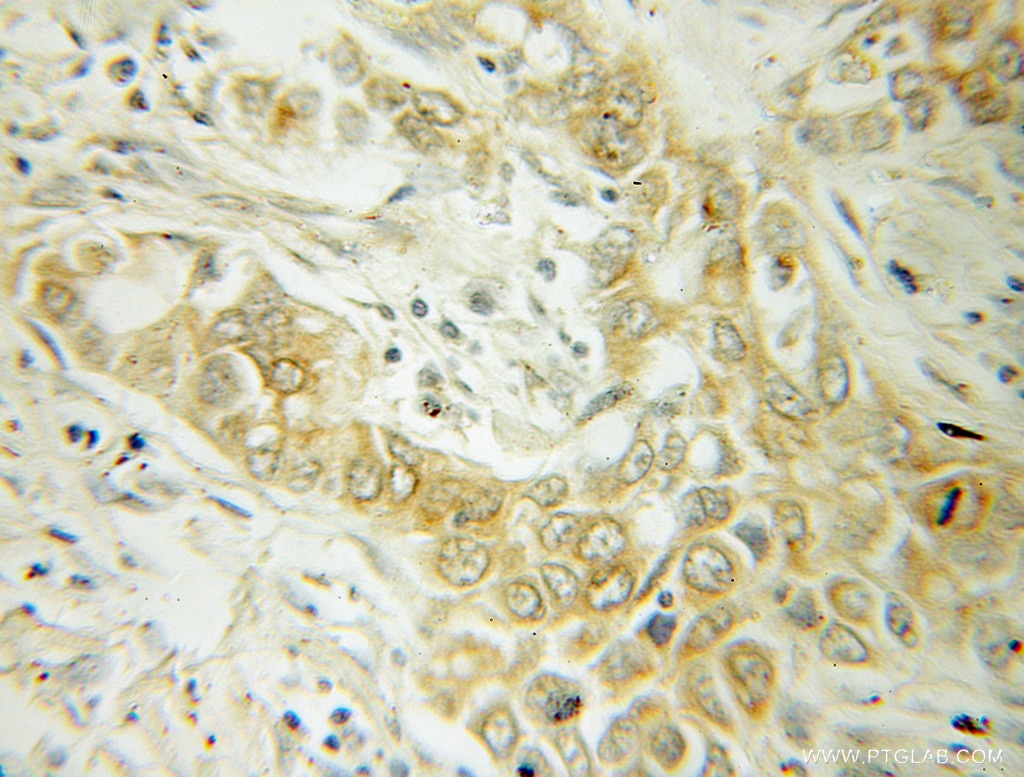 Immunohistochemistry (IHC) staining of human lung cancer tissue using ABCD1 Polyclonal antibody (11159-1-AP)
