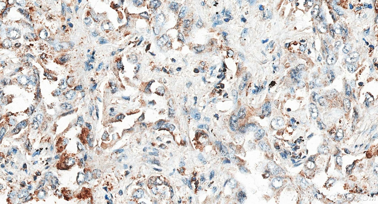 Immunohistochemistry (IHC) staining of human lung cancer tissue using ABCD1 Polyclonal antibody (18138-1-AP)