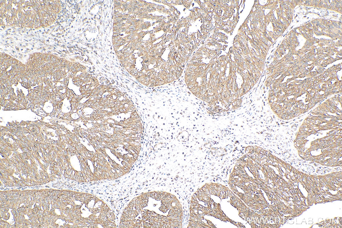 Immunohistochemistry (IHC) staining of human ovary cancer tissue using ABCD2 Polyclonal antibody (18179-1-AP)