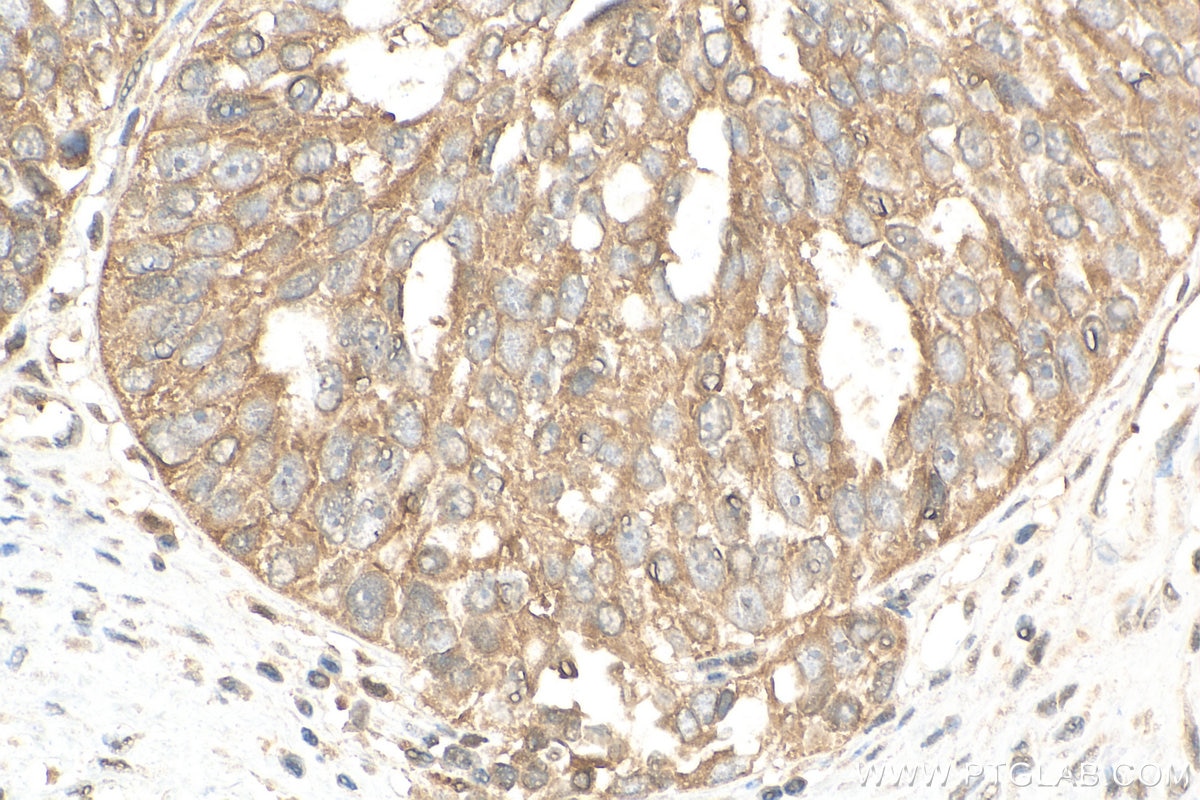 Immunohistochemistry (IHC) staining of human ovary cancer tissue using ABCD2 Polyclonal antibody (18179-1-AP)