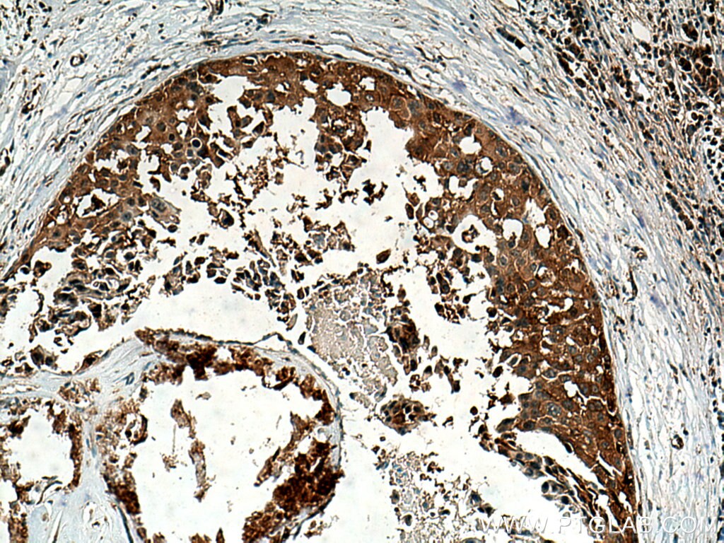 Immunohistochemistry (IHC) staining of human breast cancer tissue using ABCE1 Polyclonal antibody (28548-1-AP)