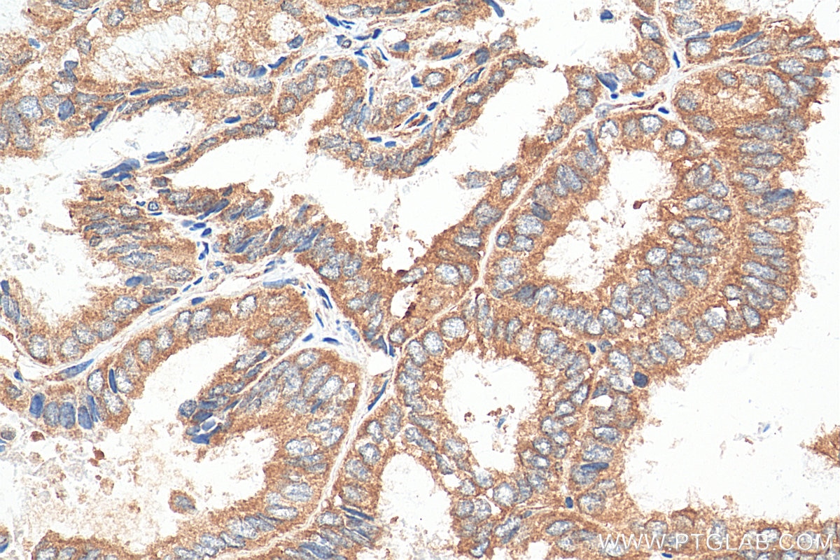 Immunohistochemistry (IHC) staining of human ovary tumor tissue using ABCE1 Polyclonal antibody (28548-1-AP)