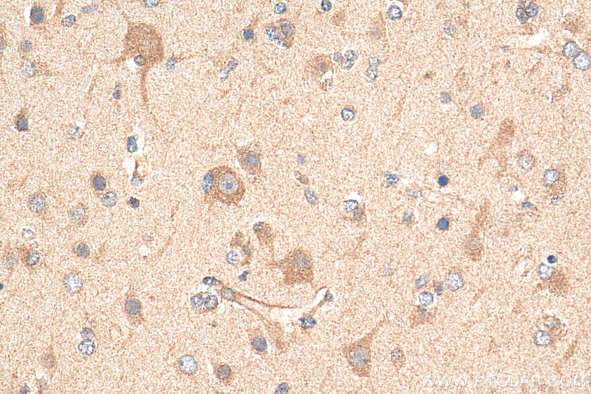 Immunohistochemistry (IHC) staining of human gliomas tissue using ABCE1 Polyclonal antibody (28548-1-AP)