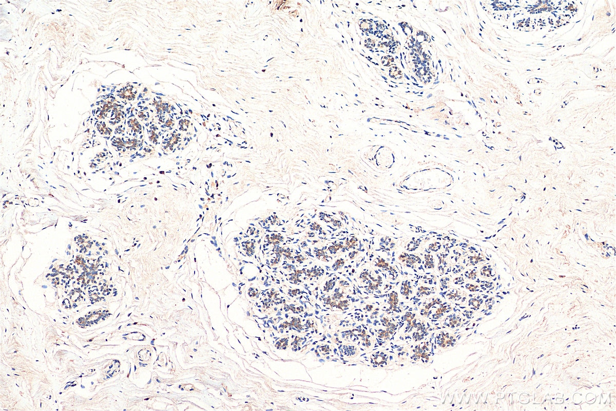 Immunohistochemistry (IHC) staining of human breast cancer tissue using ABCE1 Monoclonal antibody (67960-1-Ig)