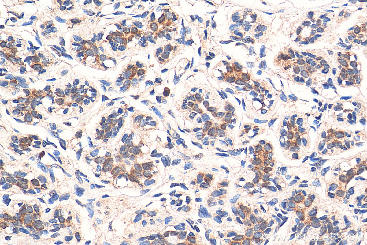 Immunohistochemistry (IHC) staining of human breast cancer tissue using ABCE1 Monoclonal antibody (67960-1-Ig)