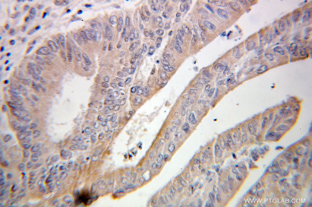 Immunohistochemistry (IHC) staining of human colon cancer tissue using ABCF2 Polyclonal antibody (10226-1-AP)