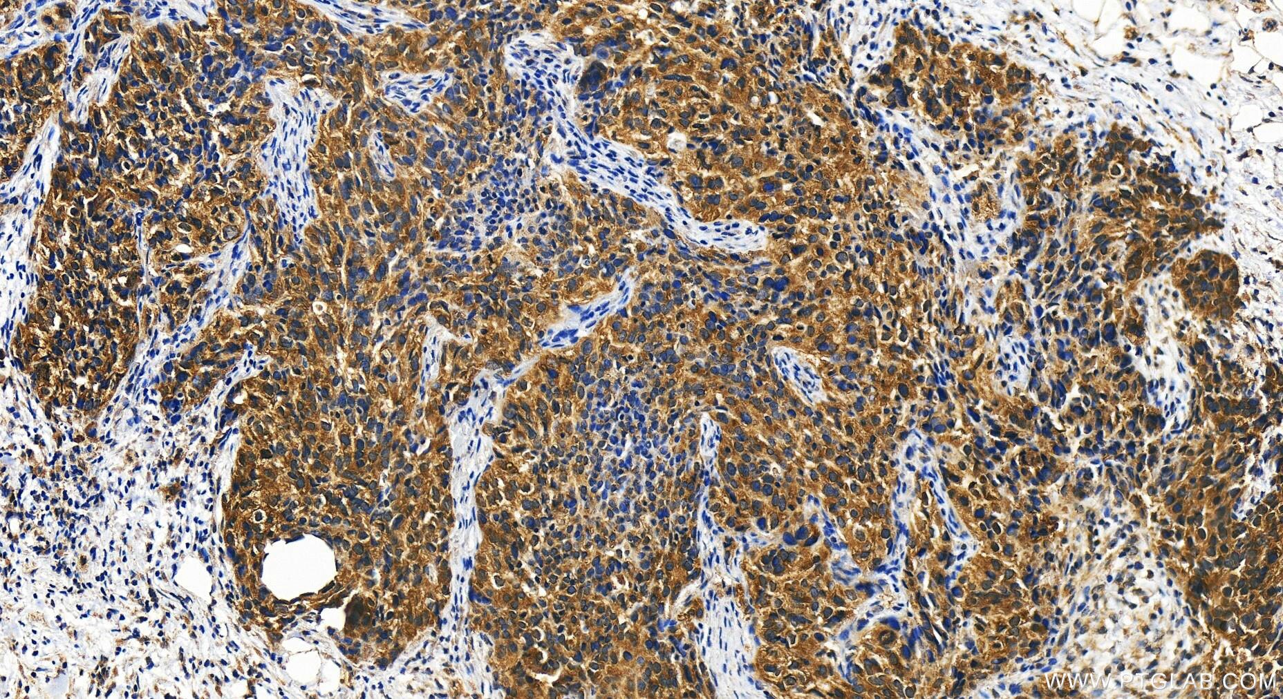 Immunohistochemistry (IHC) staining of human ovary cancer tissue using ABCF3 Polyclonal antibody (15984-1-AP)