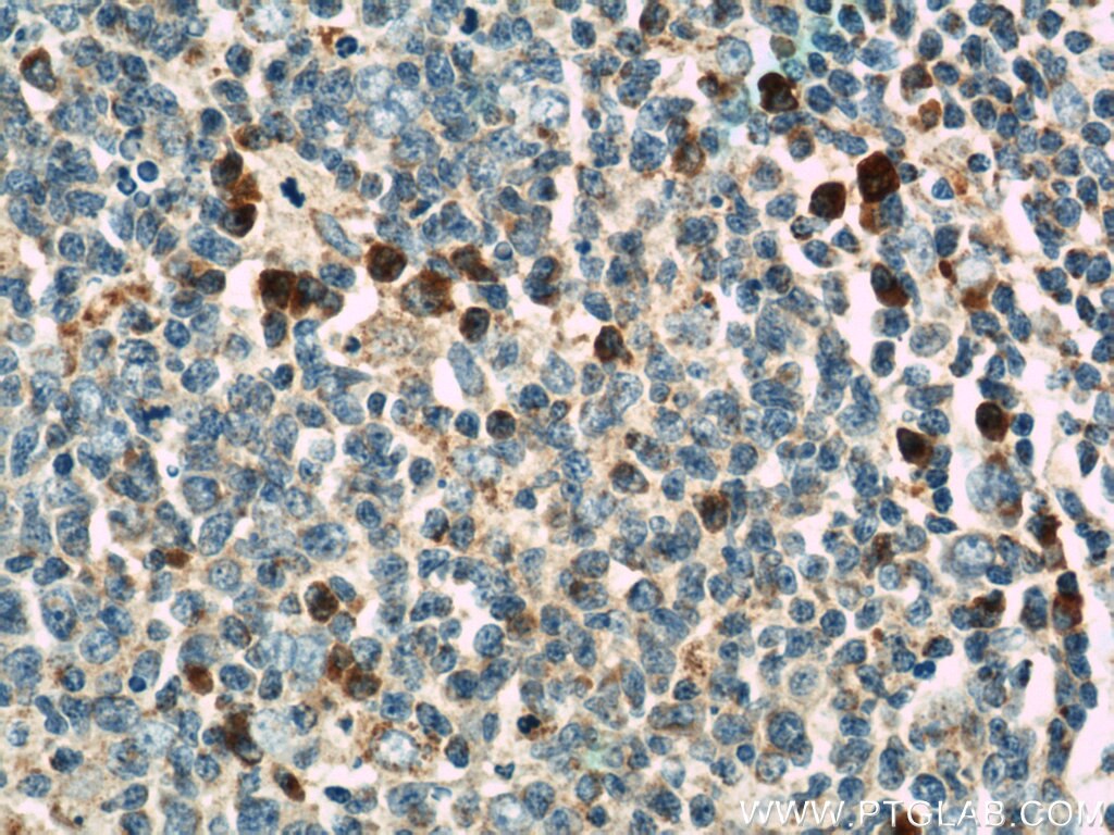 Immunohistochemistry (IHC) staining of human tonsillitis tissue using ABCG1 Polyclonal antibody (13578-1-AP)
