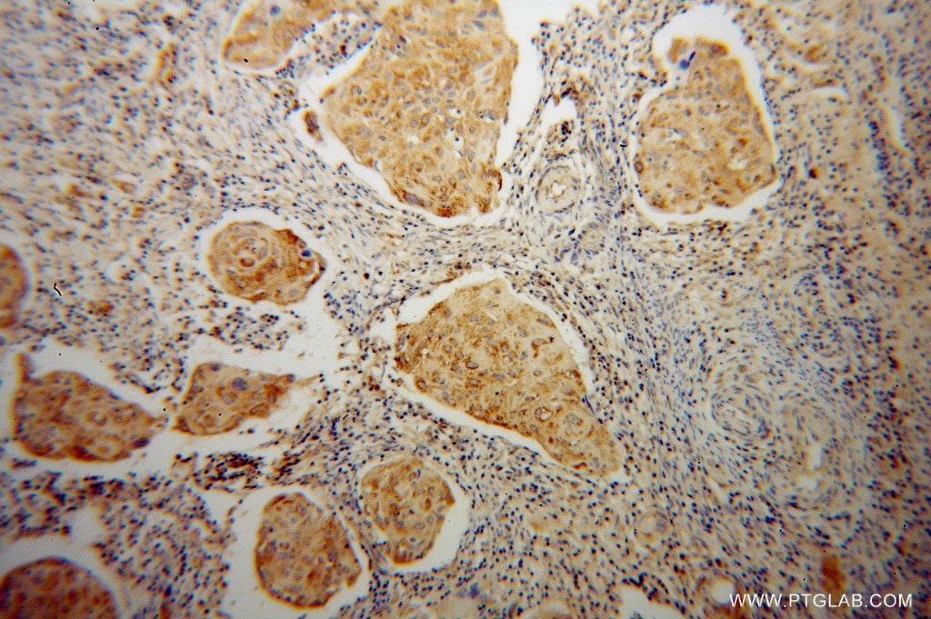 Immunohistochemistry (IHC) staining of human cervical cancer tissue using ABCG1 Polyclonal antibody (13578-1-AP)