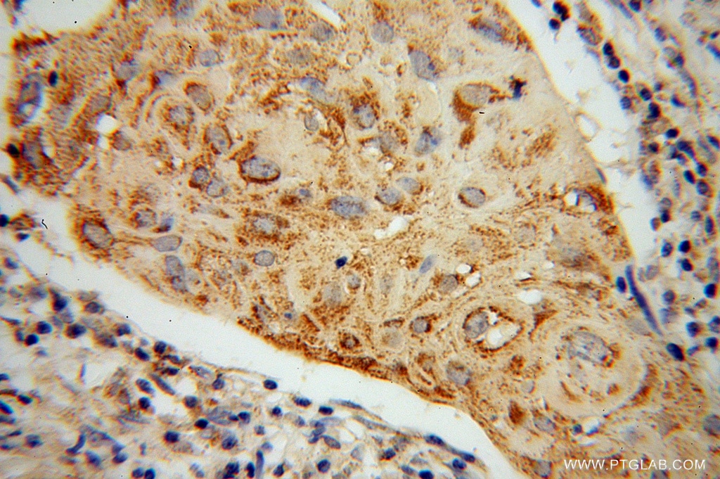 Immunohistochemistry (IHC) staining of human cervical cancer tissue using ABCG1 Polyclonal antibody (13578-1-AP)