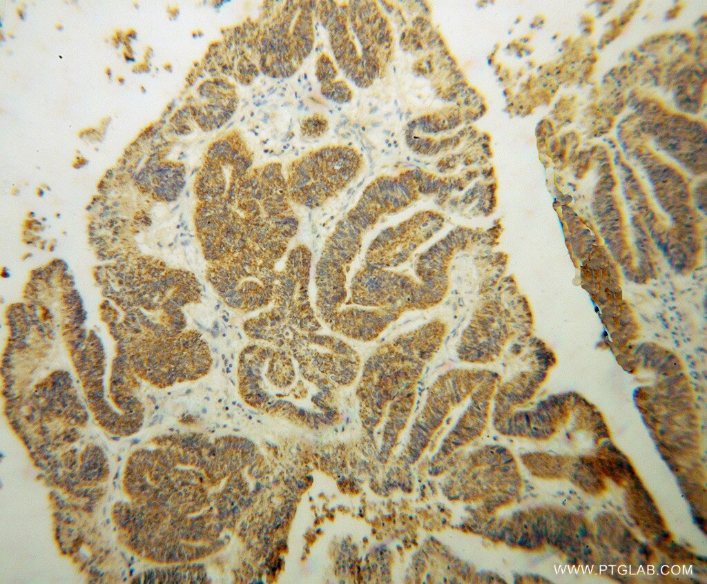 IHC staining of human liver cancer using 14269-1-AP