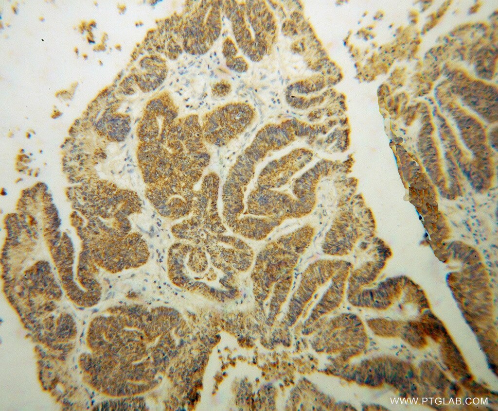 Immunohistochemistry (IHC) staining of human liver cancer tissue using ABCG4 Polyclonal antibody (14269-1-AP)