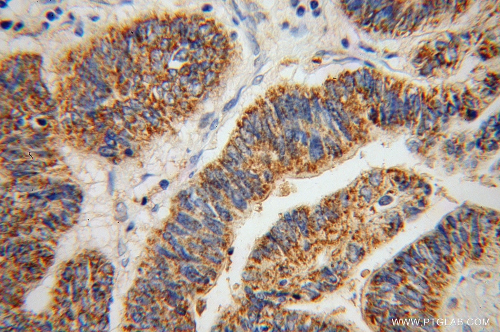 Immunohistochemistry (IHC) staining of human liver cancer tissue using ABCG4 Polyclonal antibody (14269-1-AP)