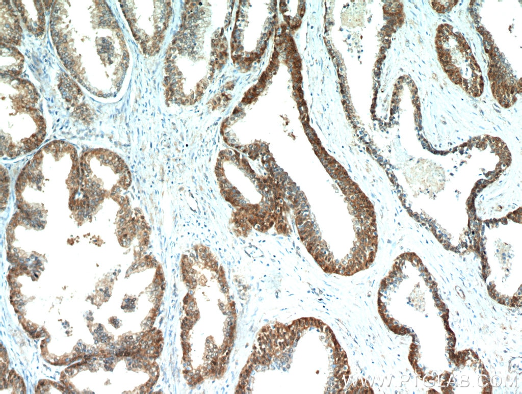 Immunohistochemistry (IHC) staining of human prostate hyperplasia tissue using ABHD14B Polyclonal antibody (20952-1-AP)