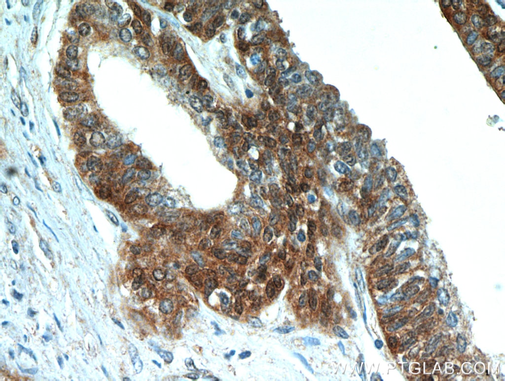 Immunohistochemistry (IHC) staining of human prostate hyperplasia tissue using ABHD14B Polyclonal antibody (20952-1-AP)