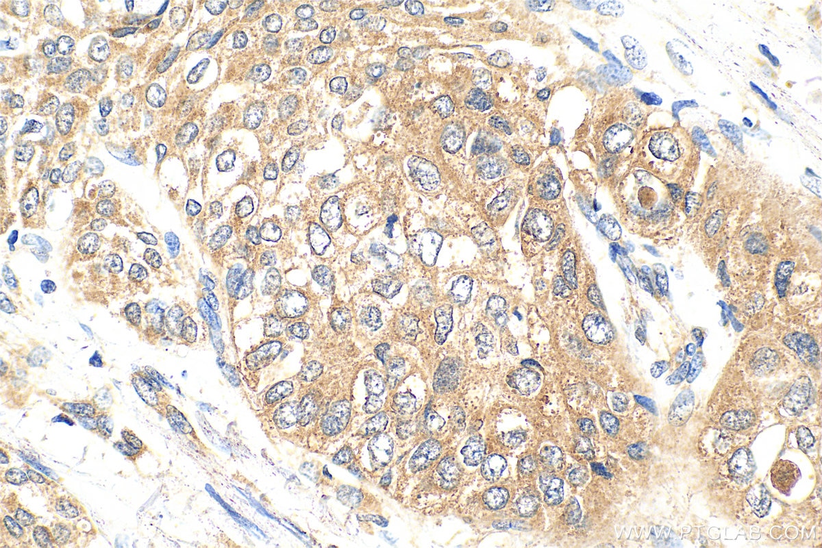 Immunohistochemical analysis of paraffin-embedded human urothelial carcinoma tissue slide using 32036-1-AP (ABHD4 antibody) at dilution of 1:200 (under 40x lens). Heat mediated antigen retrieval with Tris-EDTA buffer (pH 9.0). Immunohistochemistry (IHC) staining of human urothelial carcinoma tissue using ABHD4 Polyclonal antibody (32036-1-AP)