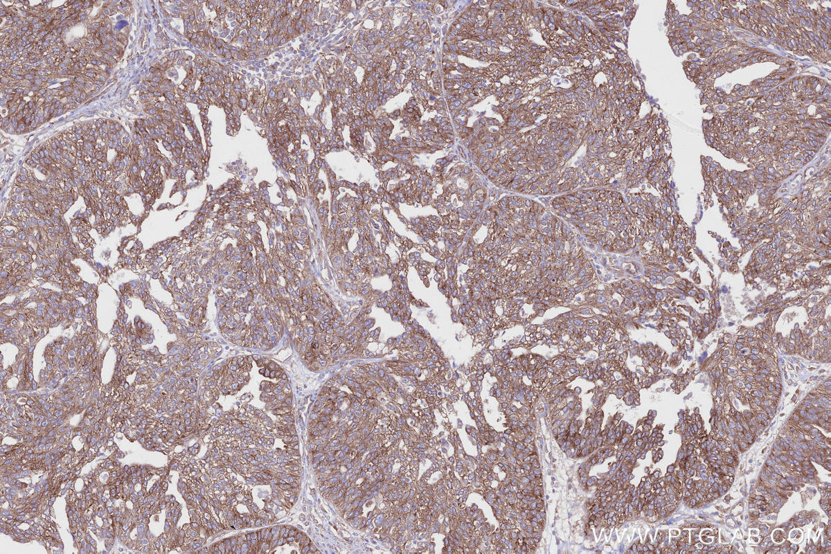 Immunohistochemistry (IHC) staining of human ovary cancer tissue using ABI1 Polyclonal antibody (27387-1-AP)