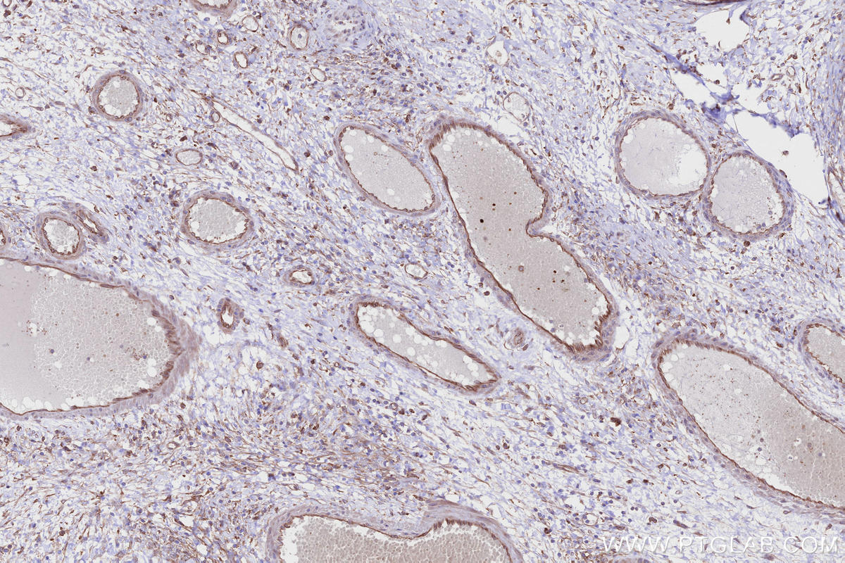Immunohistochemistry (IHC) staining of human ovary cancer tissue using ABI1 Polyclonal antibody (27387-1-AP)