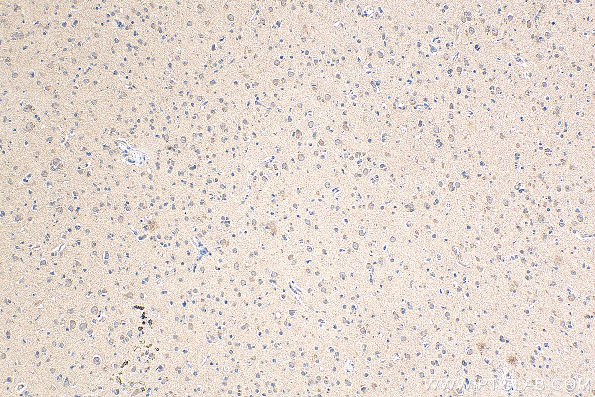 Immunohistochemistry (IHC) staining of human gliomas tissue using ABL2 Polyclonal antibody (17693-1-AP)