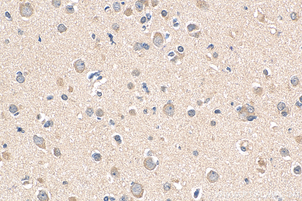 Immunohistochemistry (IHC) staining of human gliomas tissue using ABL2 Polyclonal antibody (17693-1-AP)