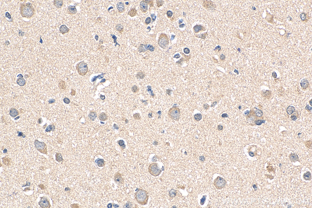 IHC staining of human gliomas using 17693-1-AP