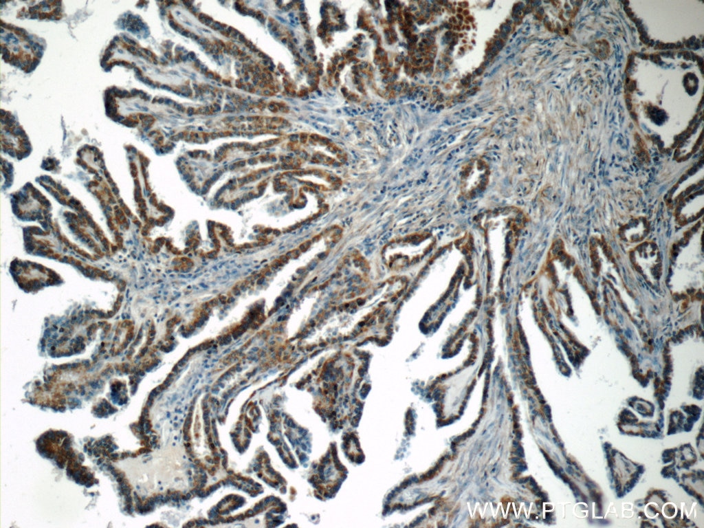 Immunohistochemistry (IHC) staining of human thyroid cancer tissue using ACAA1 Polyclonal antibody (12319-2-AP)