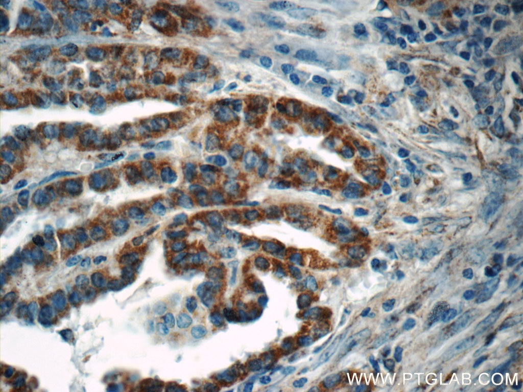 Immunohistochemistry (IHC) staining of human thyroid cancer tissue using ACAA1 Polyclonal antibody (12319-2-AP)