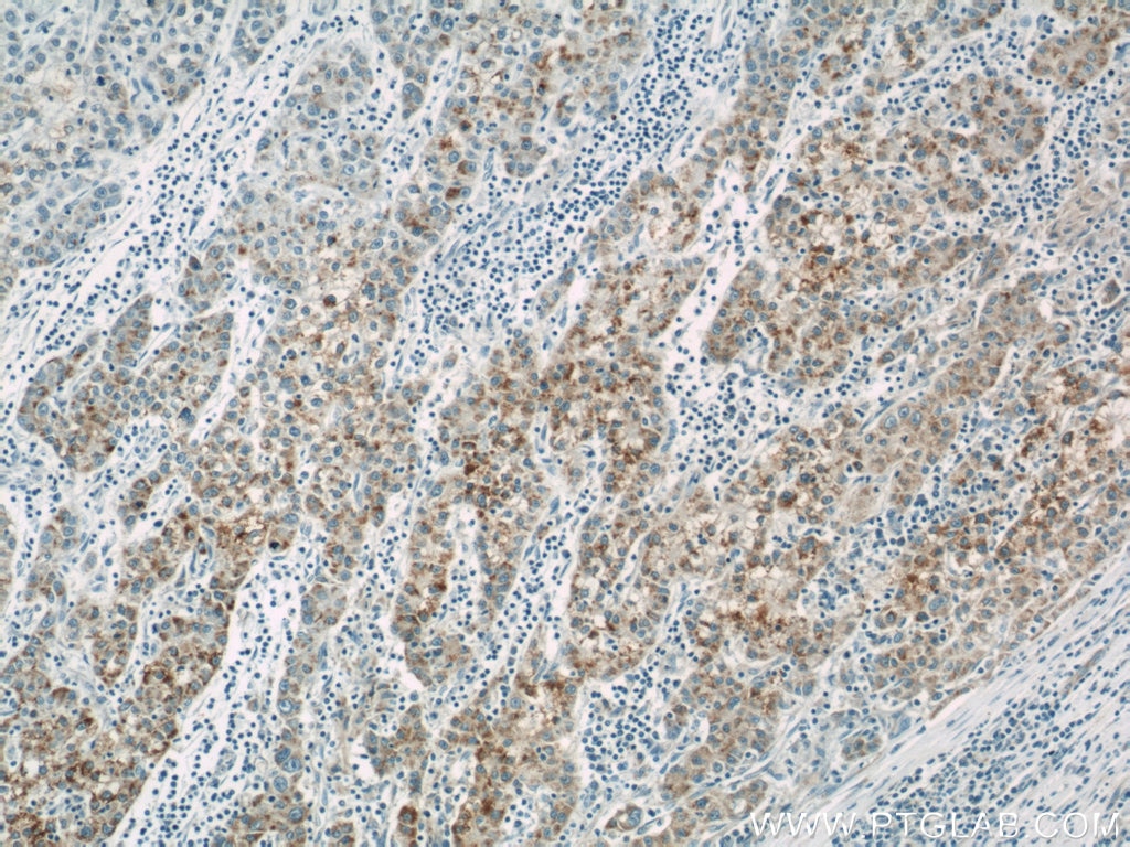 Immunohistochemistry (IHC) staining of human liver cancer tissue using ACAA1 Polyclonal antibody (12319-2-AP)