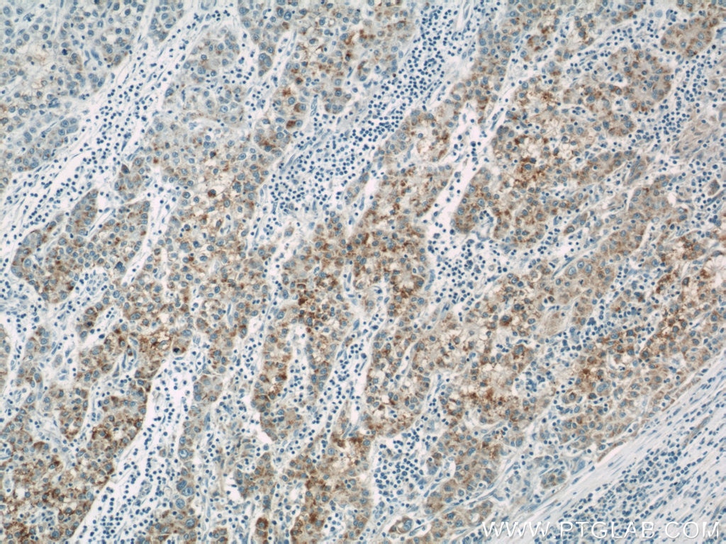 IHC staining of human liver cancer using 12319-2-AP